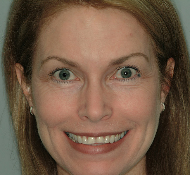Incorporating Orthodontics into Restorative Treatment to Improve Long
