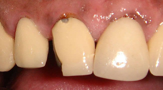 Dental Porcelain Repair Kit Glass Ceramic Fracture Teeth Dentures