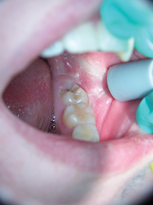 Dental Lasers December 2012 Inside Dentistry