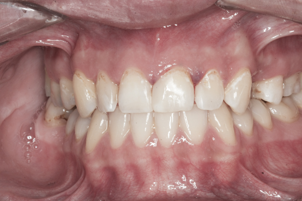 Determining the Best Protocol for Early Caries Lesions