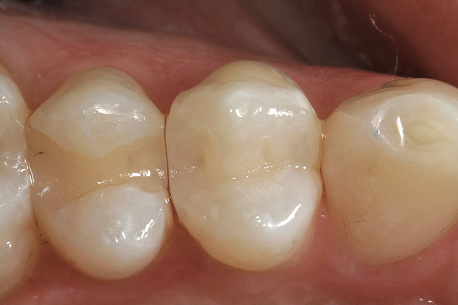 Esthetics: Sectional Matrices And The Restoration Of Class Ii Direct Composite  Restorations | October 2008 | Inside Dentistry