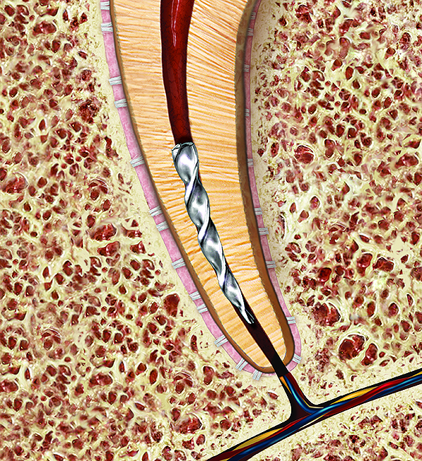 Preventing and Remedying Endodontic Rotary NiTi File Breakage January 2015 Inside Dentistry