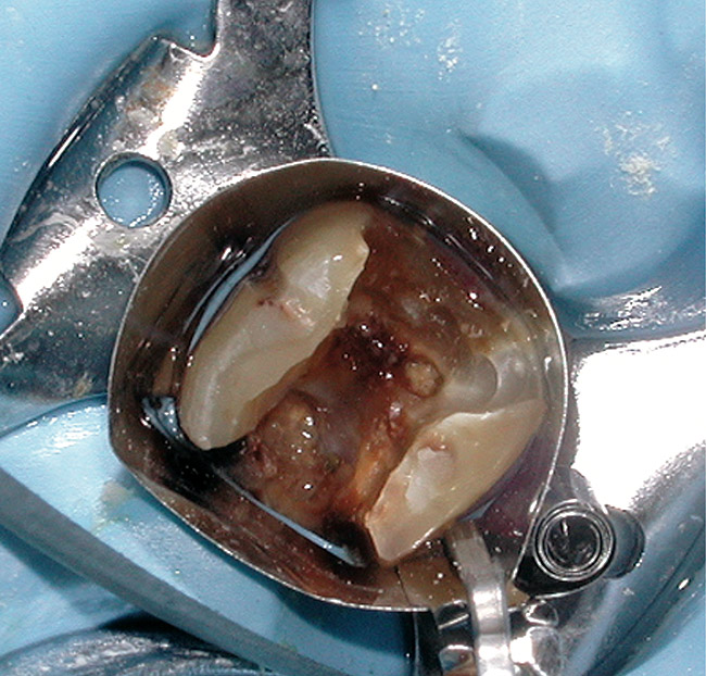 Endodontics Improving Endodontic Success Through Coronal Leakage