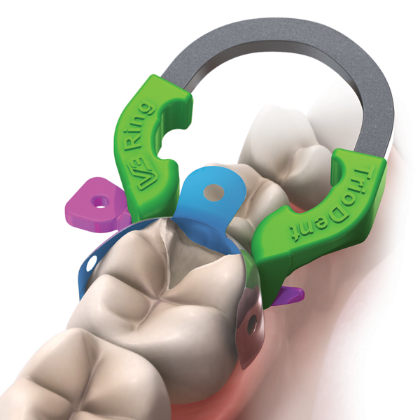 Versatile V3 Sectional Matrix System Streamlines Class II Composite