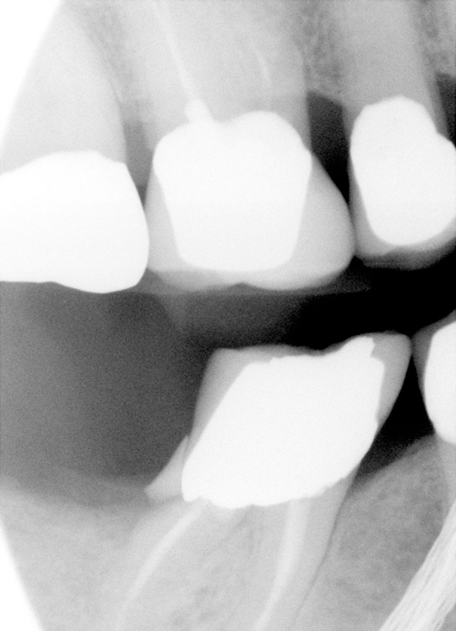 Crown Repair Using Glass Ionomer Nov/Dec 2008 Inside Dentistry