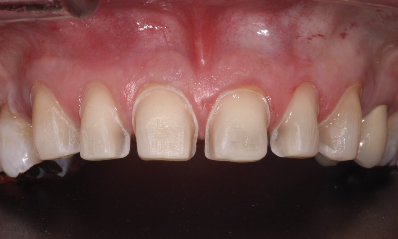 Preparation Design and Armamentarium for Lithium Disilicate Restorations |  November 2015 | Strategies for Achieving Optimal Outcomes with IPS e.max  and Other Modern Ceramic Materials