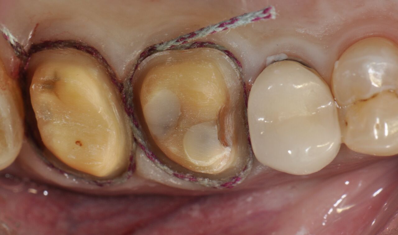 Preparation Design and Armamentarium for Lithium Disilicate Restorations |  November 2015 | Strategies for Achieving Optimal Outcomes with IPS e.max  and Other Modern Ceramic Materials