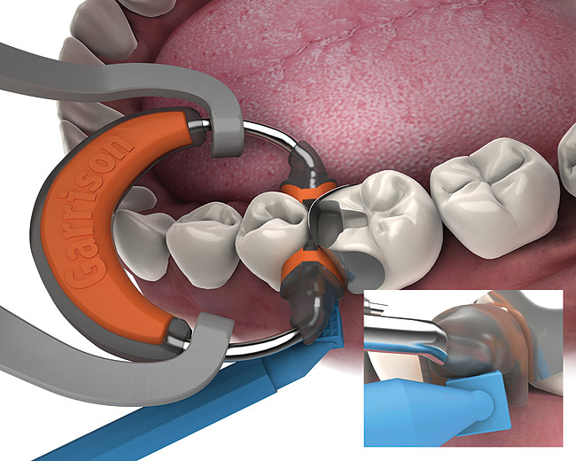 New Sectional Matrix System Simplifies Posterior Direct