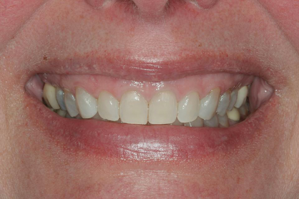 Elimination of a “Gummy Smile” With Crown Lengthening and Lip