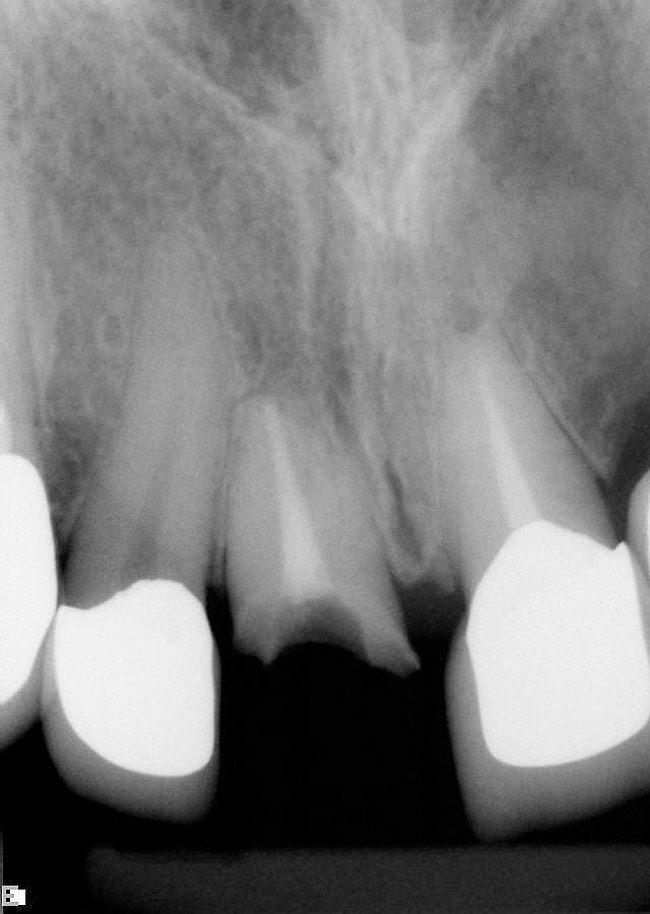 The Immediate Anterior Implant and Provisional Crown March 2009 Inside Dentistry