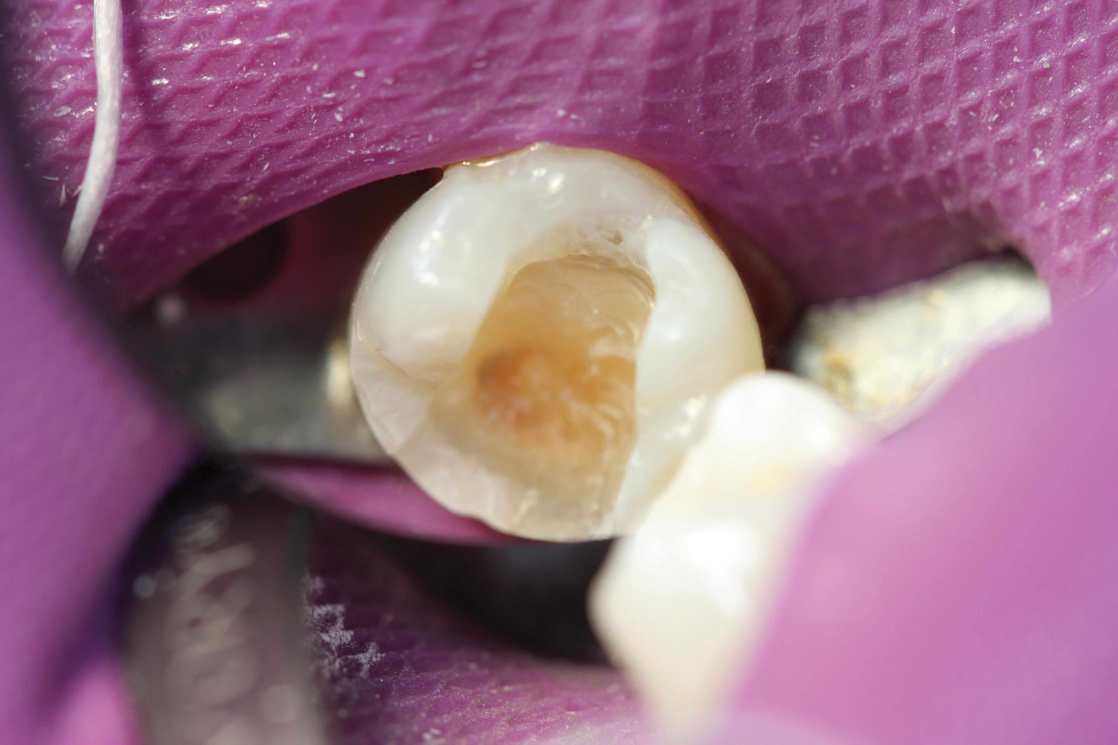 Bioactive Dental Materials February 2016 Inside Dentistry