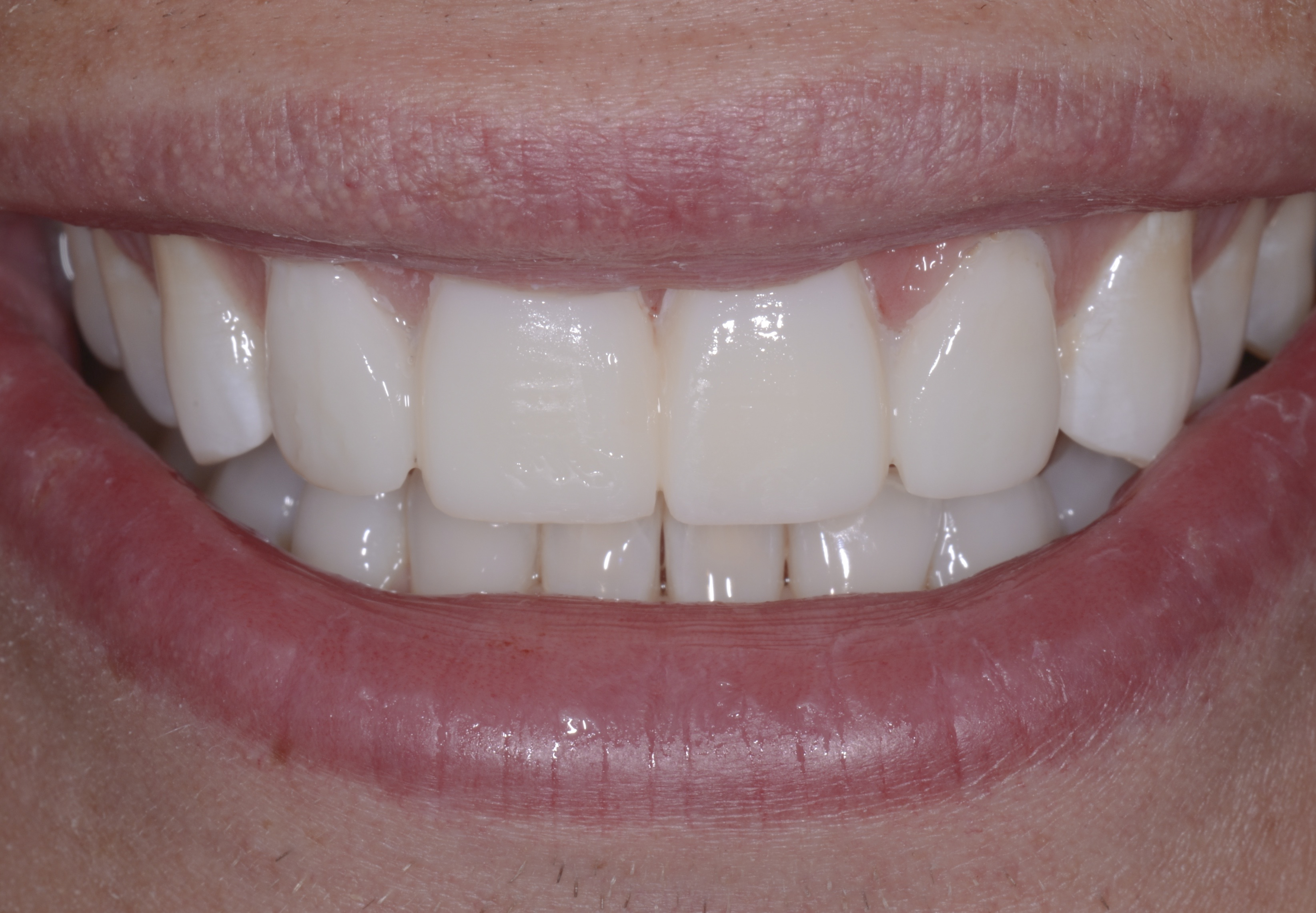 Closing the Gap Between Esthetics and Digital Dentistry | February 2016 |  Compendium