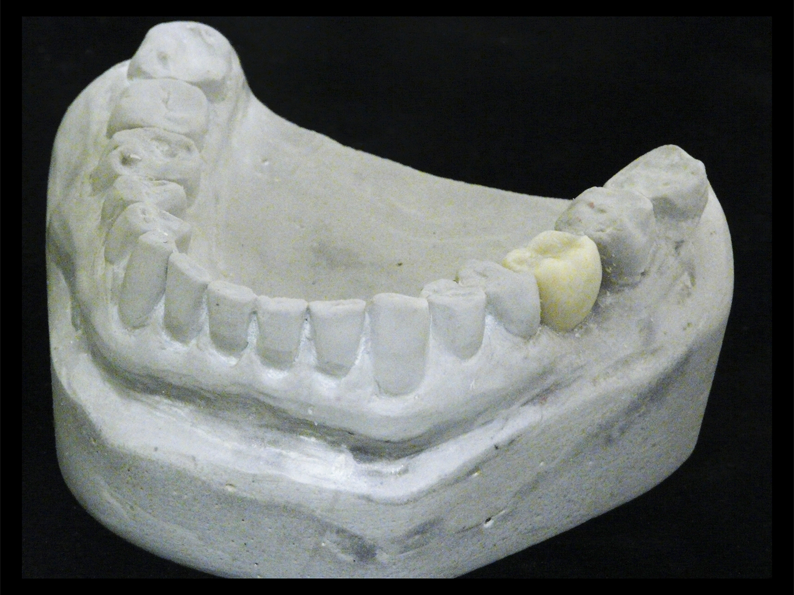 Delivery of a Posterior FullContour Zirconia Implant Crown April 2016 Inside Dentistry