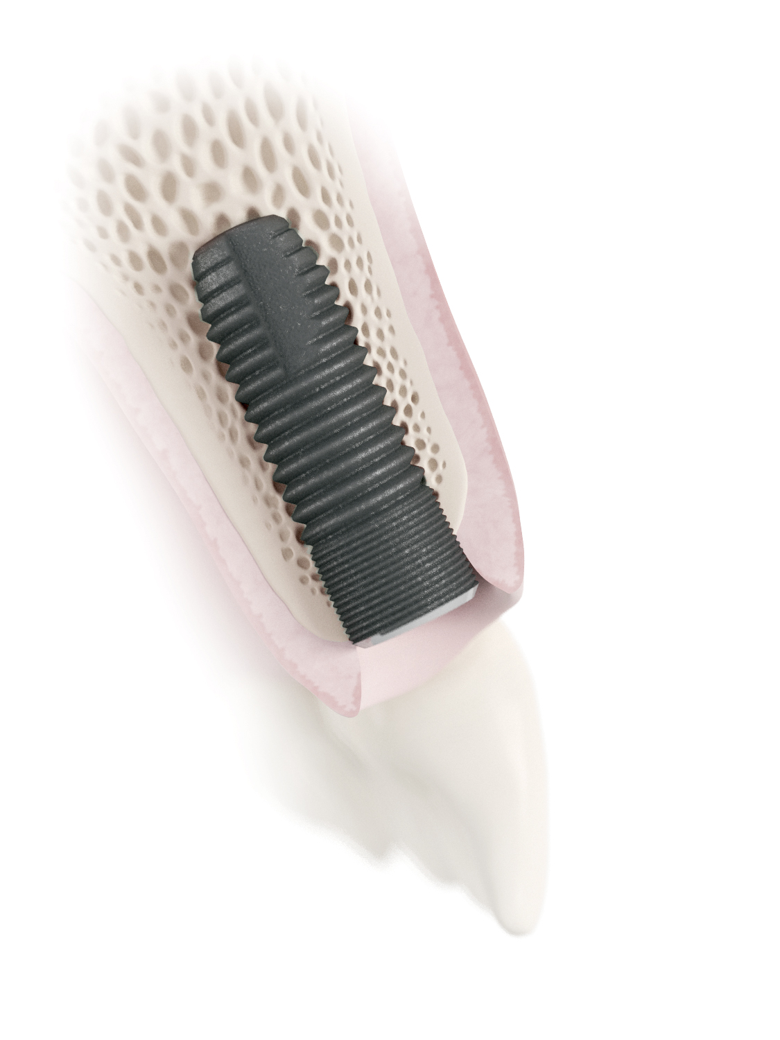 Dentsply Implants May 2016 Inside Dentistry