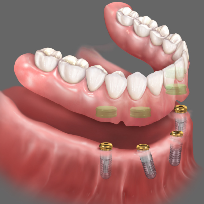 All Systems Go: Delivering Full Solutions for Implant Cases