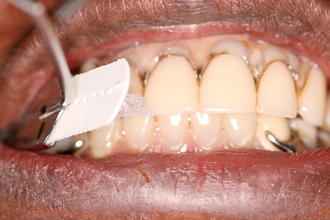 Retrofitting Crowns to an Existing Removable Partial Denture Using a Dual-Arch Impression Technique