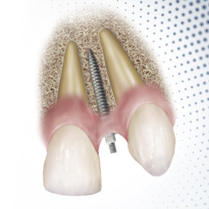 Increasing Case Acceptance with Narrow Diameter Implants Ebook Library Image