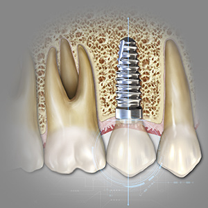 Decision Making in Implantology Ebook Library Image