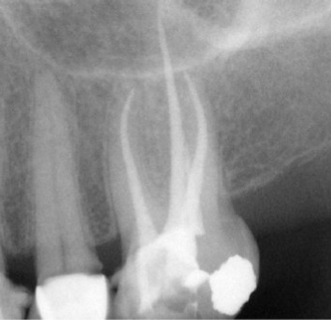 Adhesive Endodontic Obturation Nov/Dec 2009 Inside Dentistry