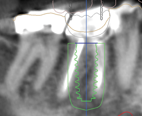 How has digital dentistry improved implantology?