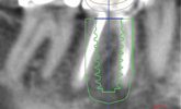 How does digital technology help with implant placement?