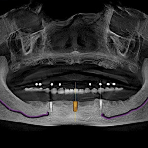 The Implant-Occlusal Connection Ebook Library Image