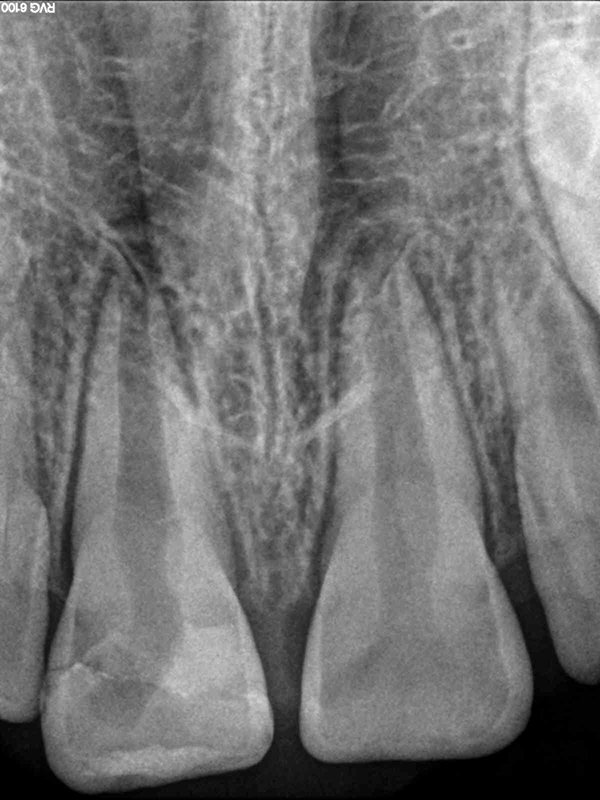Regenerative Endodontics November 2017 Inside Dentistry