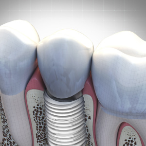 Updates in Implantology Ebook Library Image
