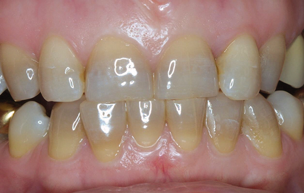 Image result for tetracycline stained teeth