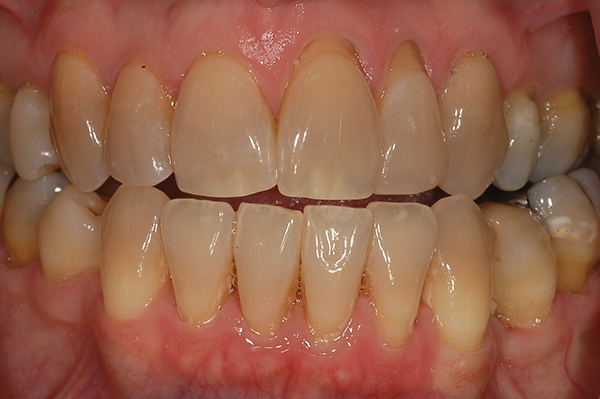 Bleaching Tetracycline Stained Teeth Inside Dentistry,Cat Colors Pictures