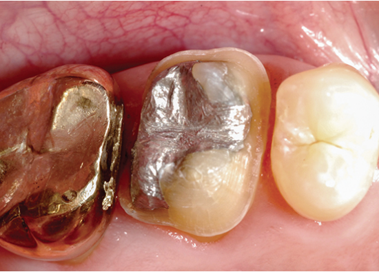 What are best practices for restoring interproximal surfaces?