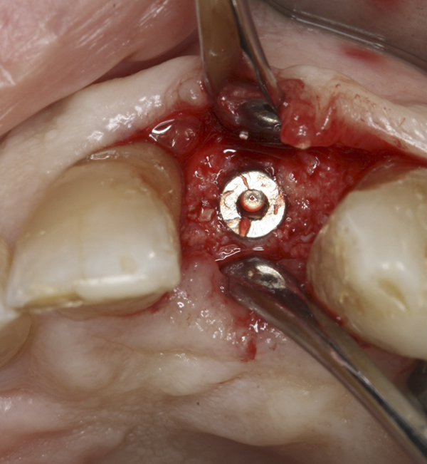 After 8 months from the regenerative surgery, the implant was placed