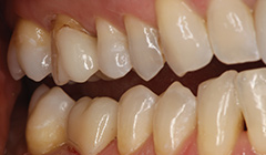 The Myths and Realities of Today's Zirconia Restorative Materials