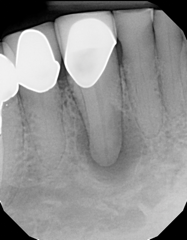 Successful SingleCone Obturation March 2018 Inside Dentistry