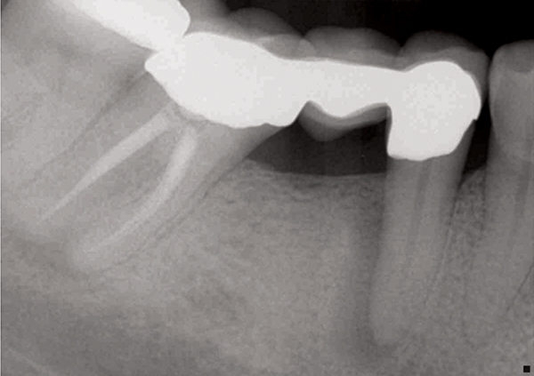 Understanding Periodontal-Endodontic Infections