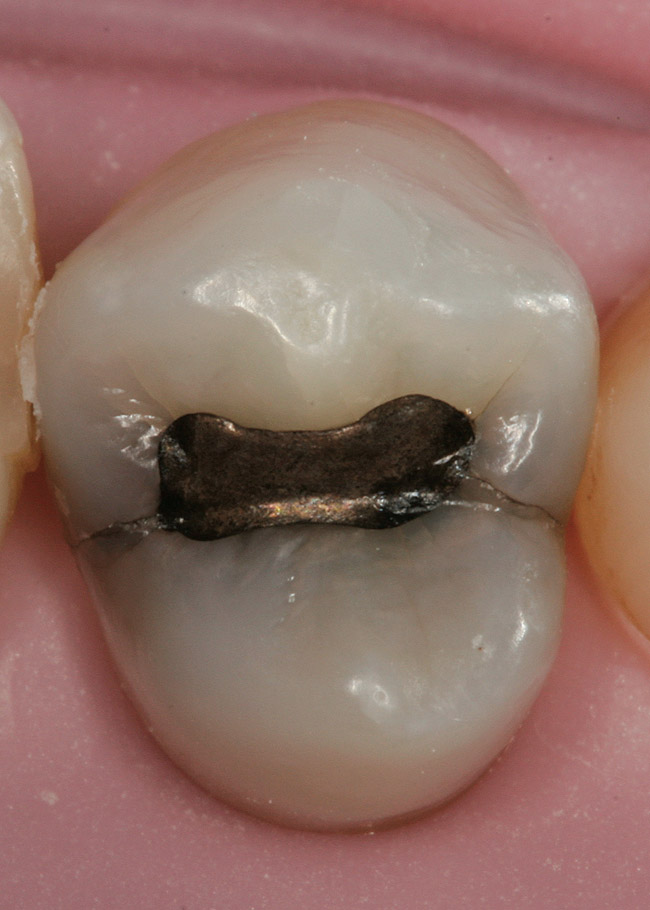Restoration of an 'At Risk' Tooth Jul/Aug 2010 Inside Dentistry