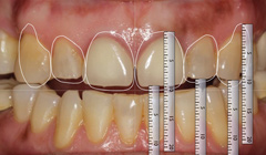 Using Digital Smile Design to Yield Predictable Results
