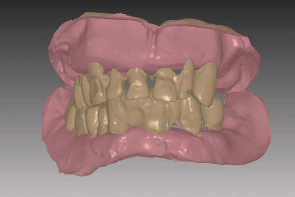 Digital Denture Diagnostics