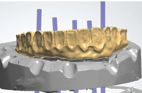 The Metal-Zirconia Implant Fixed Hybrid Full-Arch Prosthesis