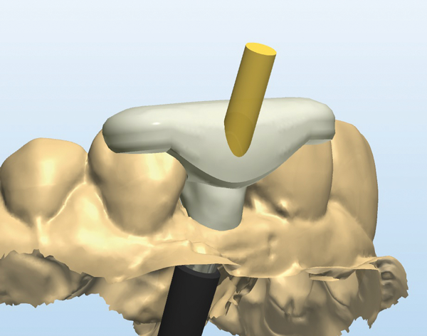 Innovative Strategies for Cemented Implant Restorations