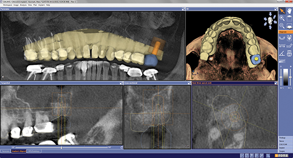 CAD/CAM Restorations for the Digitally Integrated Dental Practice