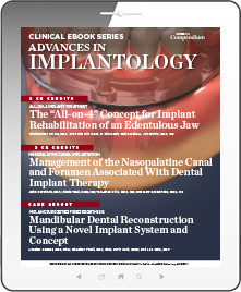 Advances in Implantology Ebook Cover