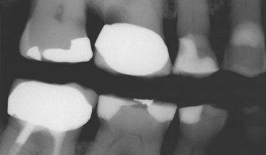 Principles of Post and Core Dentistry