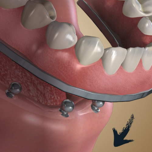 Advances in Prosthodontics Ebook Library Image