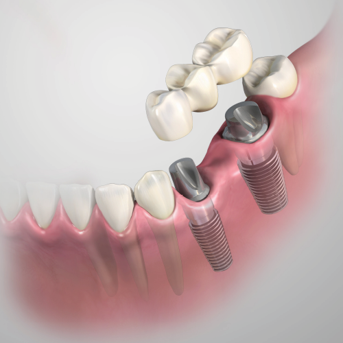 Current Trends and New Beginnings for Retaining Restorations on Dental Implants Ebook Library Image