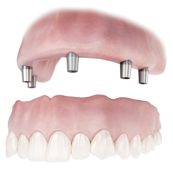 The Truth About FrictionRetained Hybrid Prostheses March 2019