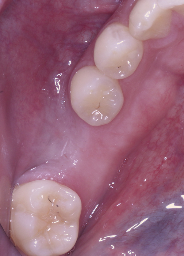 Use of ComputerGuided Surgery to Avoid Severe Buccal Defect and