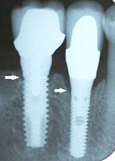 Dental Implant Xray