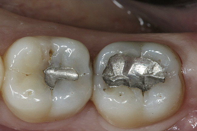 Replacing Amalgam with Composite | Inside Dentistry
