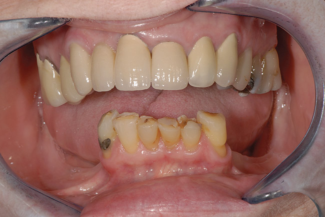 Lightning widow whiskey Diagnosis and Management of Porcelain-Induced Wear with Compensatory  Eruption | Jul/Aug 2011 | Inside Dentistry